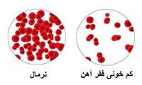 کم خونی فقر آهن چیست؟ چگونه می توان از آن پیشگیری کرد؟