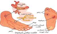 علائم خطر زخم پای دیابتی که لازم است بدانیم