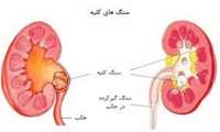 کم‌آبی؛ اصلی‌ترین عامل تشکیل ‌سنگ کلیه‌